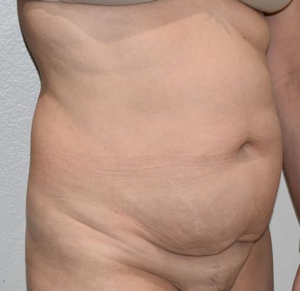 Tummy Tuck (Abdominoplasty): Case 267 - Before