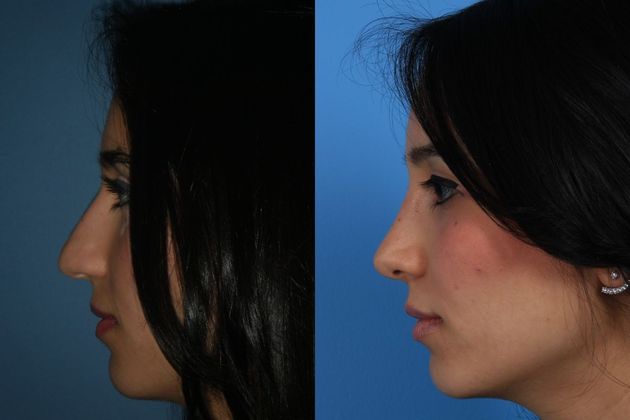 Rhinoplasty: Case 2
