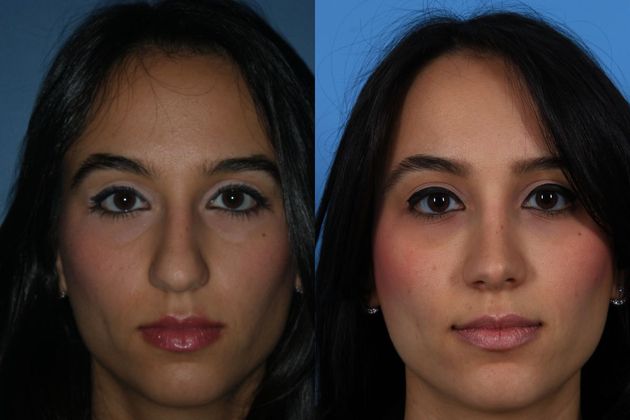 Rhinoplasty Case 2