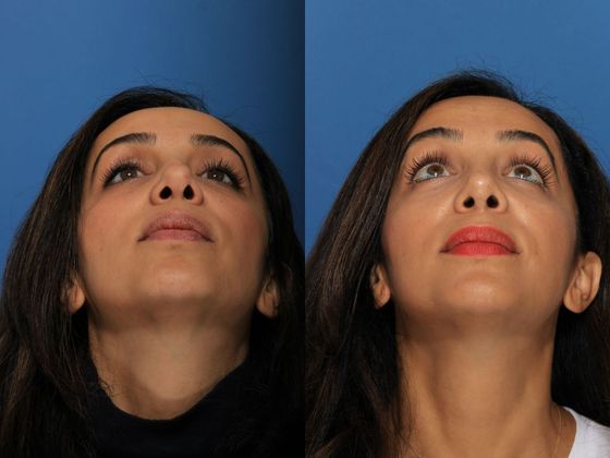 Revision Rhinoplasty : Case 1