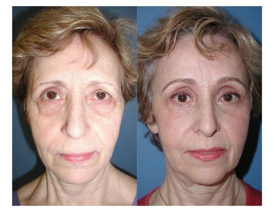 Blepharoplasty Case 5