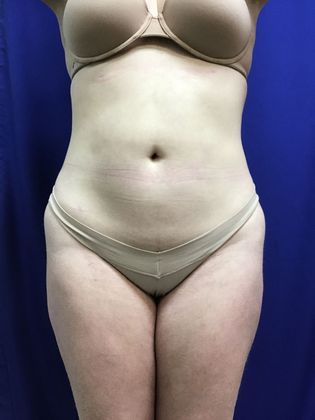 Body Buttock Enhancement: Case 5 (30636) - After