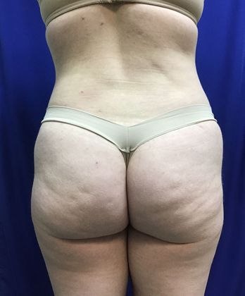 Body Buttock Enhancement: Case 5 (30636) - After