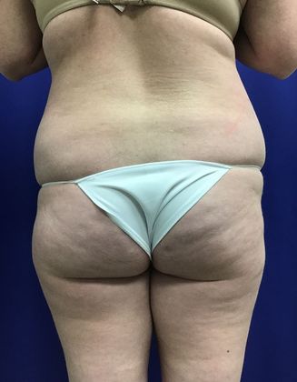 Body Buttock Enhancement: Case 5 (30636) - Before