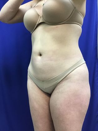 Body Buttock Enhancement: Case 5 (30636) - Before