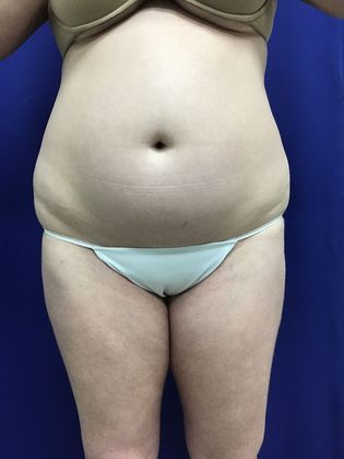 Body Liposuction: Case 10 (30636) - Before