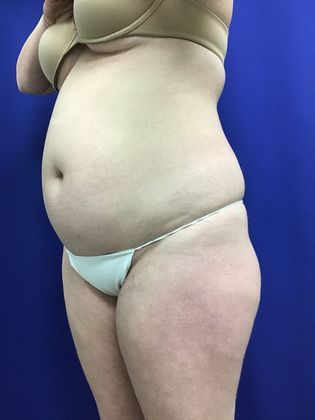 Body Liposuction: Case 10 (30636) - Before