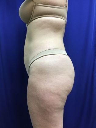 Body Liposuction: Case 10 (30636) - After