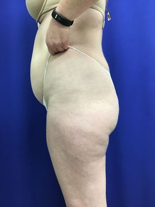 Body Liposuction: Case 10 (30636) - Before