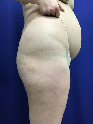 Body Liposuction: Case 10 (30636) - Before