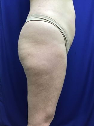 Body Liposuction: Case 10 (30636) - After