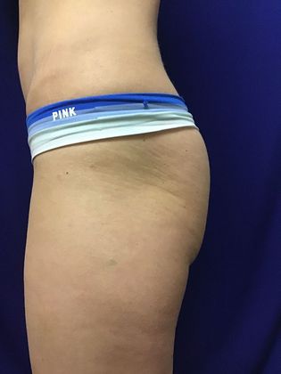 Cooltone Muscle Stimulation: Case 1 (18990) - After