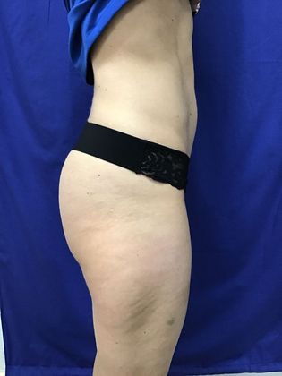 Cooltone Muscle Stimulation: Case 1 (18990) - Before