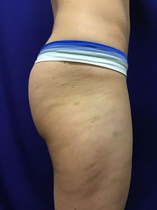 Cooltone Muscle Stimulation: Case 1 (18990) - After