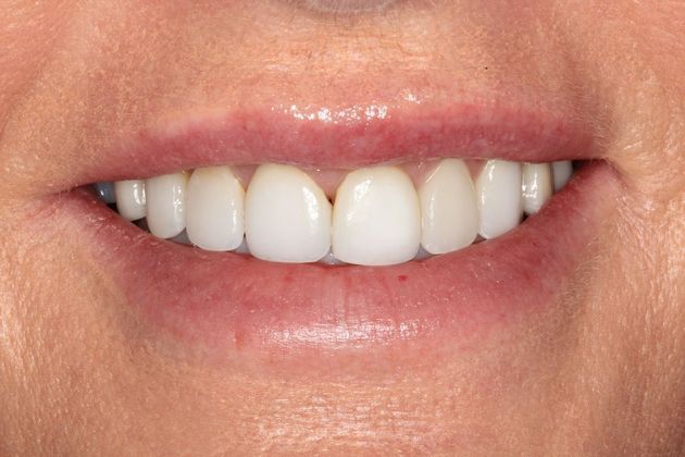 Porcelain Veneers Case 8 - Before