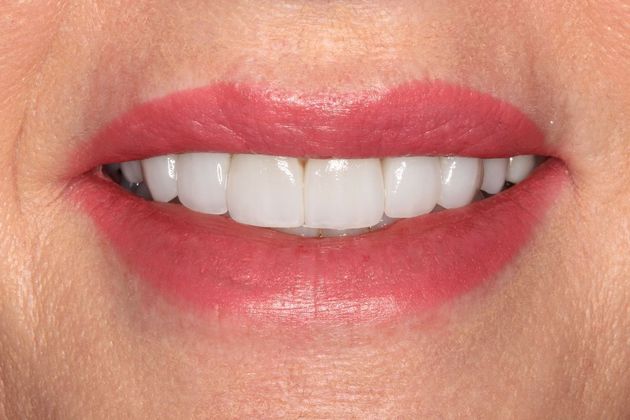 Porcelain Veneers Case 8 - After