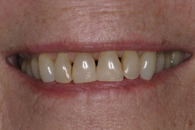 Porcelain Veneers: Case 10 - Before