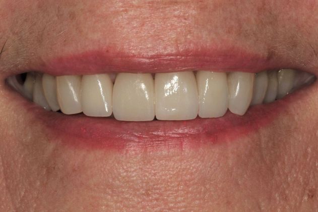 Porcelain Veneers: Case 10 - After