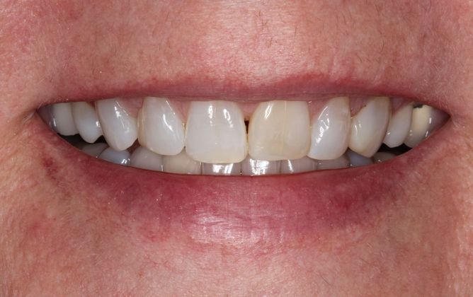 Porcelain Veneers Case 15 - Before