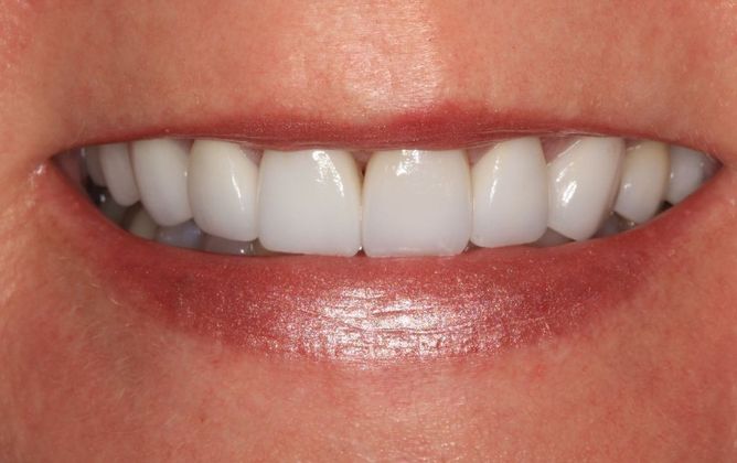 Porcelain Veneers Case 15 - After