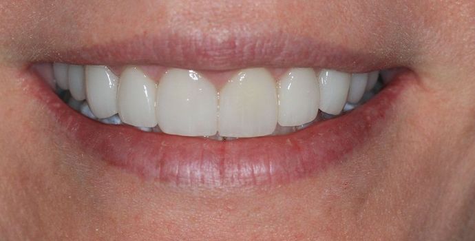 Porcelain Veneers Case 17 - After