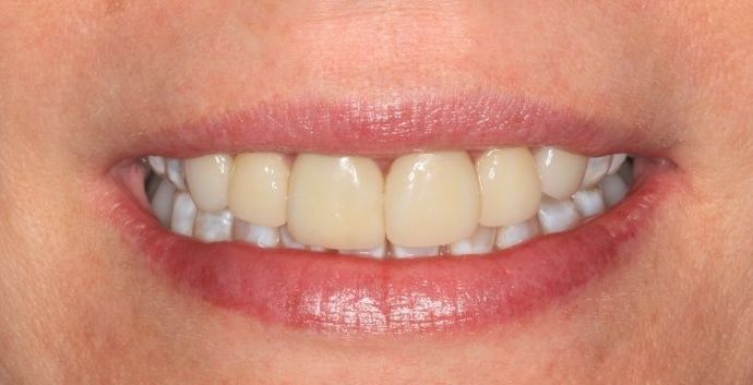 Porcelain Veneers Case 17 - Before