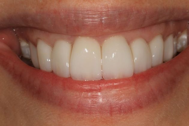 Smile Makeover: Erica - After