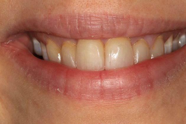 Smile Makeover: Erica - Before