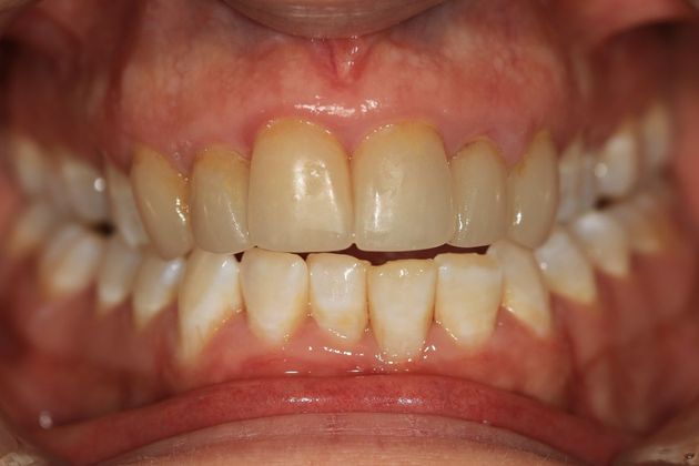 Smile Makeover: Erica - Before