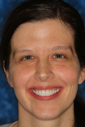 Smile Makeover: Erica - After