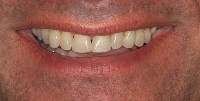 Porcelain Veneers Case 18 - Before