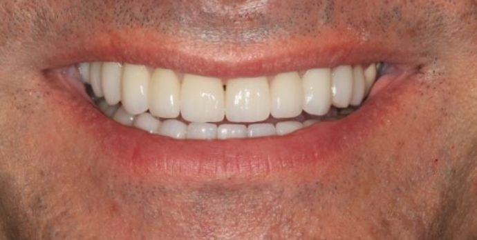Porcelain Veneers Case 18 - After