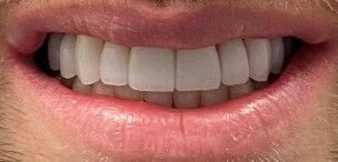 Porcelain Veneers: Case - After