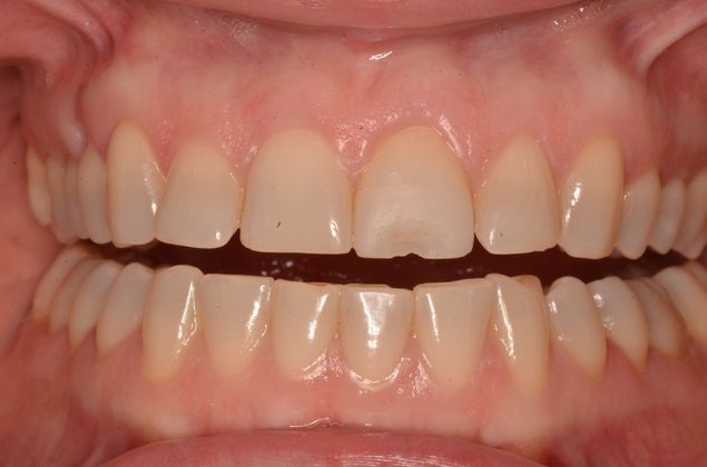 Porcelain Veneers: Case 23 - Before Porcelain veneers