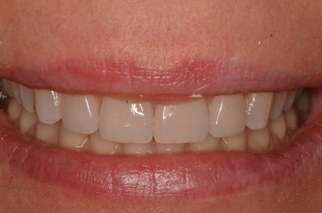Porcelain Veneers: Case 23 - After Porcelain veneers