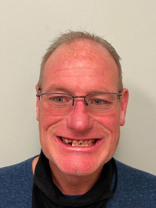 Full Mouth Reconstruction  Case 1 - Before