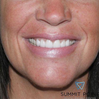 Veneers Cases