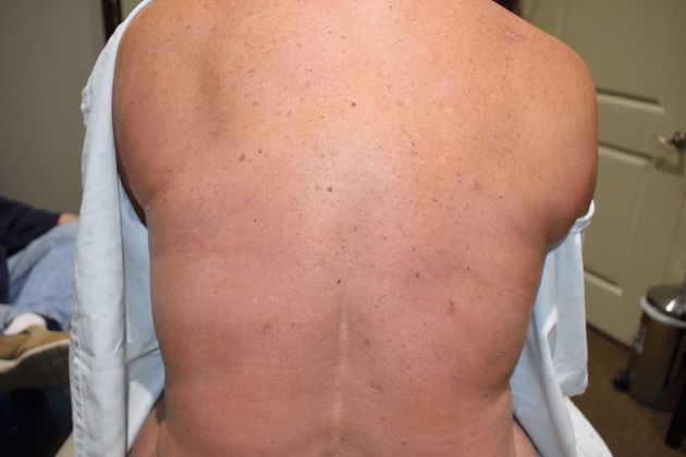 BodyTite Case 5 - After