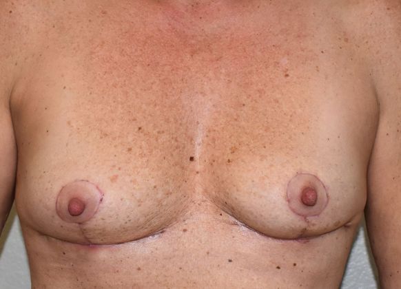 Breast Implant Removal: Case 6 - After