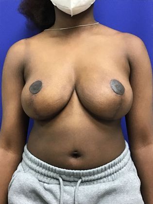 Breast Reduction: Case 31 - After