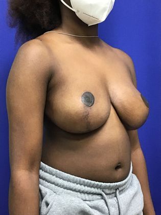 Breast Reduction: Case 31 - After