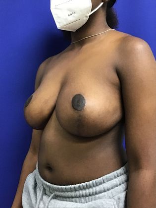 Breast Reduction: Case 31 - After