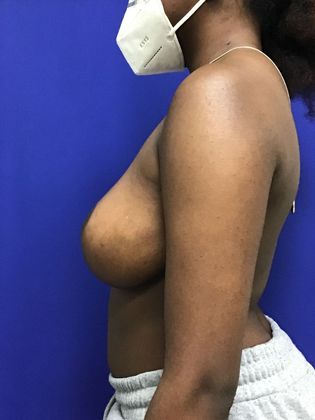 Breast Reduction: Case 31 - After