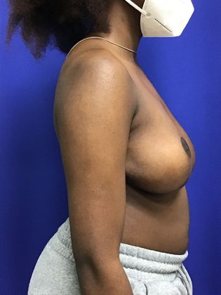 Breast Reduction: Case 31 - After