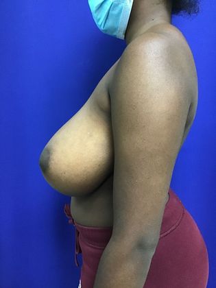 Breast Reduction: Case 31 - Before