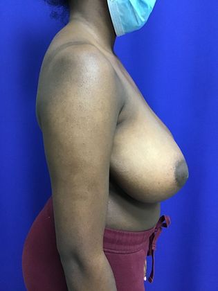 Breast Reduction: Case 31 - Before