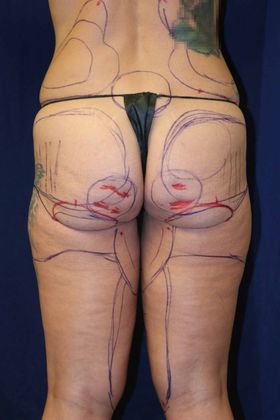 Liposuction & Safe Lipo: Case 42 - Before