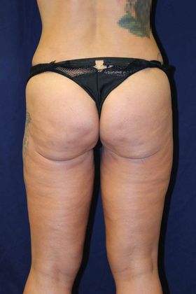 Liposuction & Safe Lipo: Case 42 - After