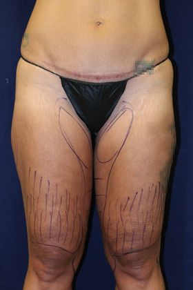 Liposuction & Safe Lipo: Case 42 - Before