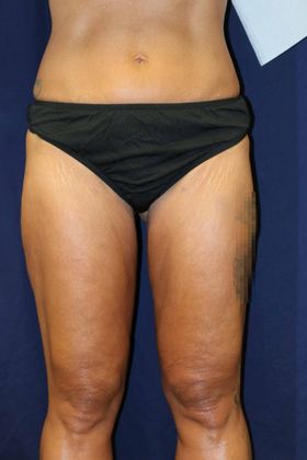 Liposuction & Safe Lipo: Case 42 - After